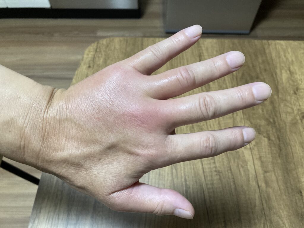 アシナガバチ コアシナガバチ 刺される 手が腫れる 強い痒み 約20時間後 翌日